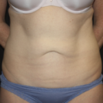 Tummy Tuck Before & After Patient #27960