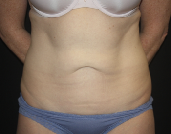 Tummy Tuck Before & After Patient #27960