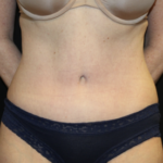 Tummy Tuck Before & After Patient #27960