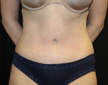 Tummy Tuck Before & After Patient #27960