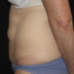 Tummy Tuck Before & After Patient #27960