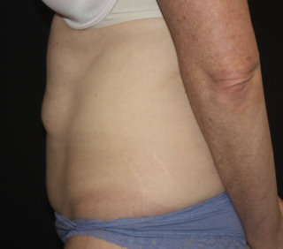 Tummy Tuck Before & After Patient #27960