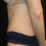 Tummy Tuck Before & After Patient #27960