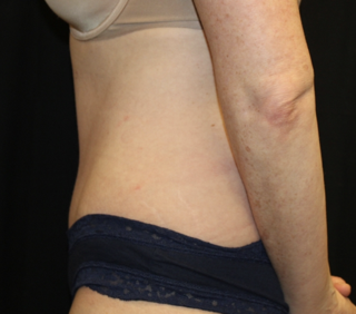 Tummy Tuck Before & After Patient #27960