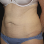 Tummy Tuck Before & After Patient #27960