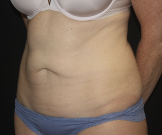 Tummy Tuck Before & After Patient #27960