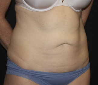 Tummy Tuck Before & After Patient #27960