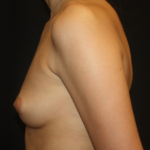 Breast Augmentation - Round Silicone Implants Before & After Patient #28138