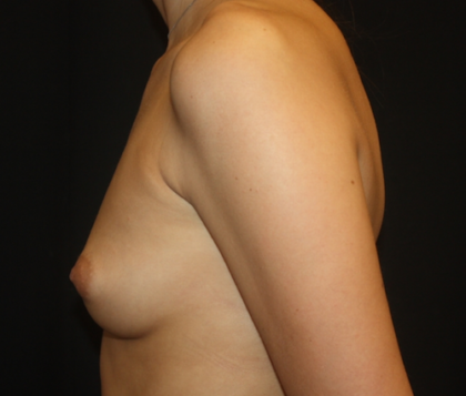 Breast Augmentation - Round Silicone Implants Before & After Patient #28138