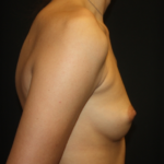 Breast Augmentation - Round Silicone Implants Before & After Patient #28138