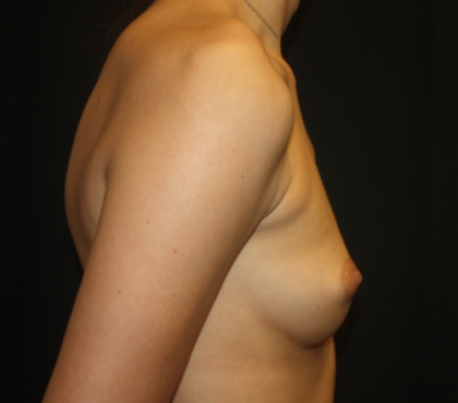 Breast Augmentation - Round Silicone Implants Before & After Patient #28138