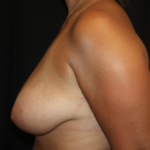 Breast Lift Before & After Patient #28075