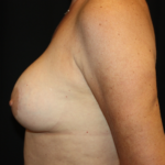 Breast Lift Before & After Patient #28156