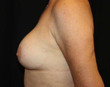 Breast Lift Before & After Patient #28156