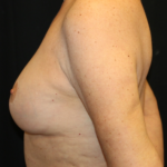 Breast Lift Before & After Patient #28156