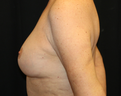 Breast Lift Before & After Patient #28156