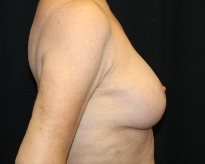 Breast Lift Before & After Patient #28156