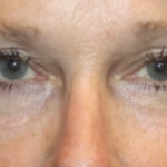 Blepharoplasty Before & After Patient #27972