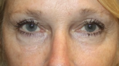 Blepharoplasty Before & After Patient #27972