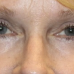 Blepharoplasty Before & After Patient #27972
