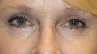 Blepharoplasty Before & After Patient #27972