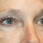 Blepharoplasty Before & After Patient #27972