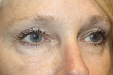 Blepharoplasty Before & After Patient #27972