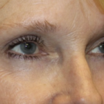 Blepharoplasty Before & After Patient #27972