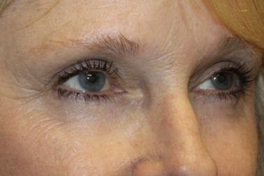 Blepharoplasty Before & After Patient #27972