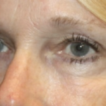 Blepharoplasty Before & After Patient #27972