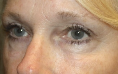 Blepharoplasty Before & After Patient #27972