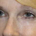 Blepharoplasty Before & After Patient #27972