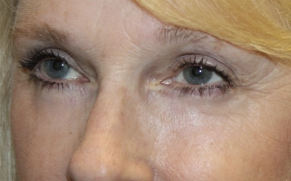 Blepharoplasty Before & After Patient #27972