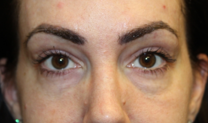 Blepharoplasty Before & After Patient #28126