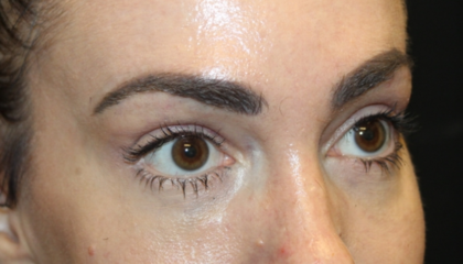 Blepharoplasty Before & After Patient #28126