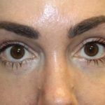 Blepharoplasty Before & After Patient #28126