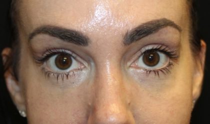 Blepharoplasty Before & After Patient #28126