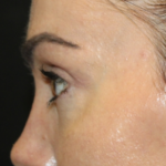 Blepharoplasty Before & After Patient #28126