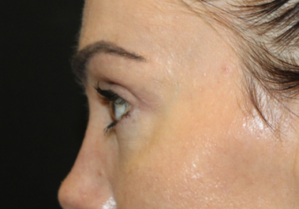 Blepharoplasty Before & After Patient #28126