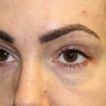 Blepharoplasty Before & After Patient #28126