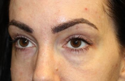 Blepharoplasty Before & After Patient #28126