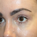 Blepharoplasty Before & After Patient #28126