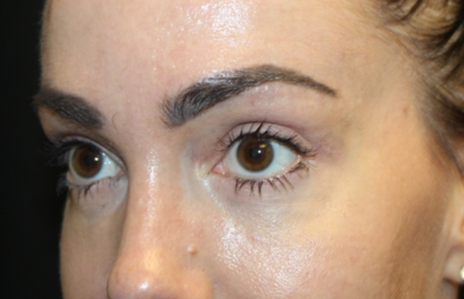 Blepharoplasty Before & After Patient #28126