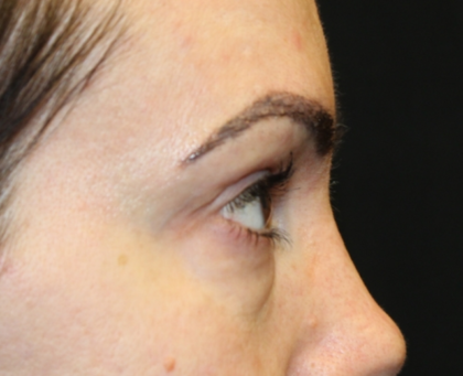 Blepharoplasty Before & After Patient #28126