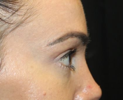 Blepharoplasty Before & After Patient #28126