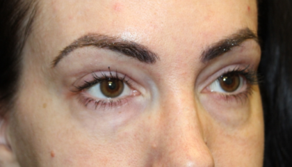 Blepharoplasty Before & After Patient #28126