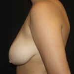 Breast Reduction Before & After Patient #28062