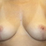 Breast Reduction Before & After Patient #27991