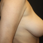 Breast Reduction Before & After Patient #27991