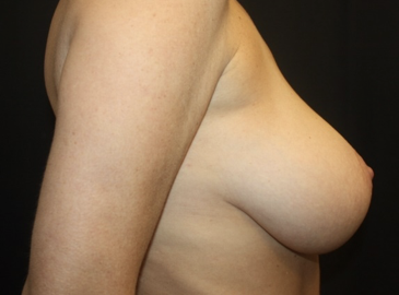 Breast Reduction Before & After Patient #27991